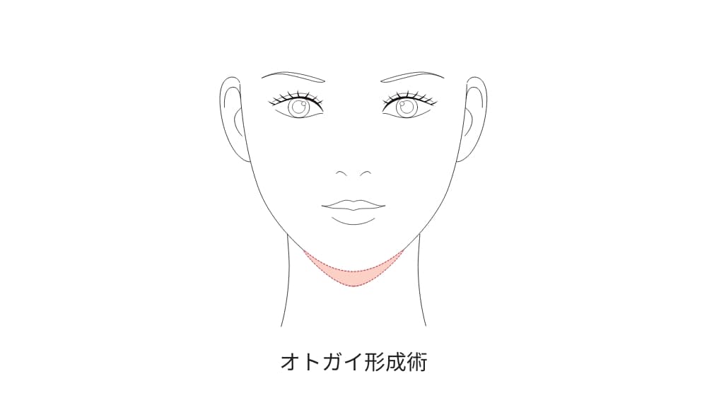 顎先整形(オトガイ形成術)