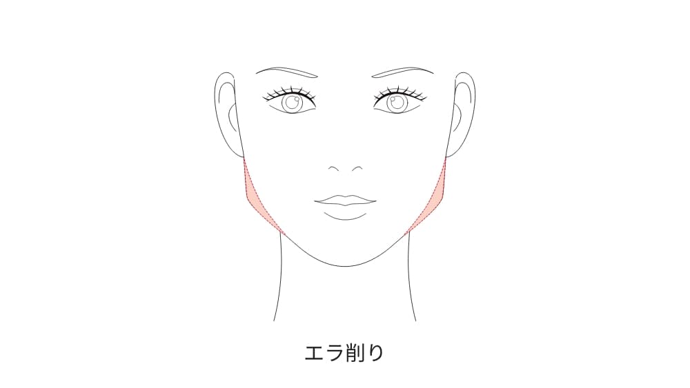 エラ削り(下顎角形成術)