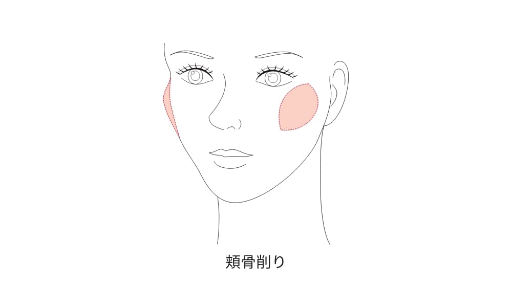 頬骨縮小術