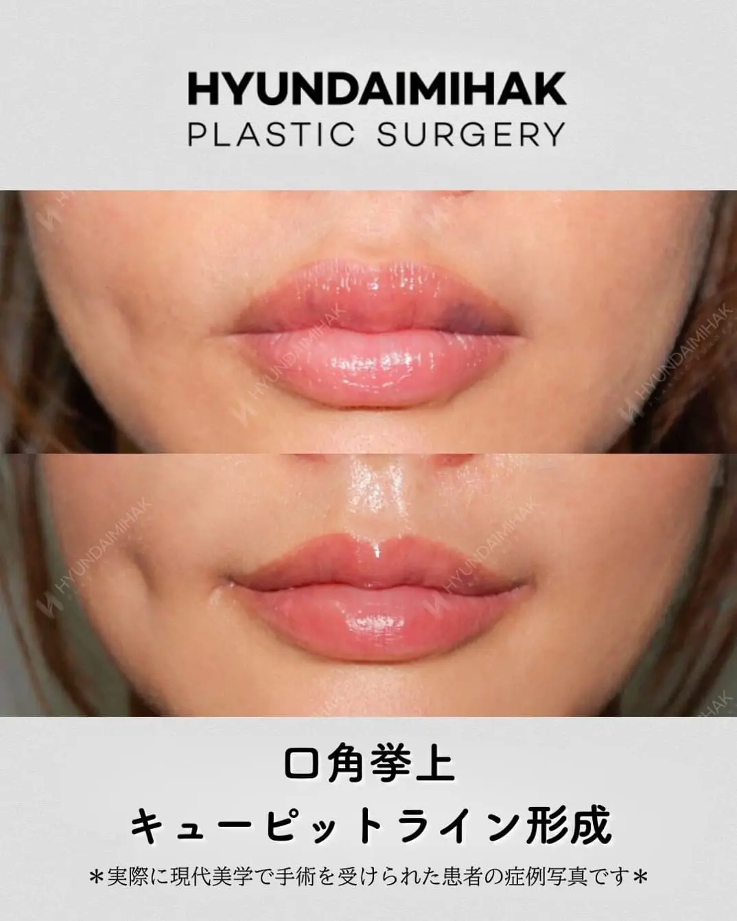 唇整形の症例