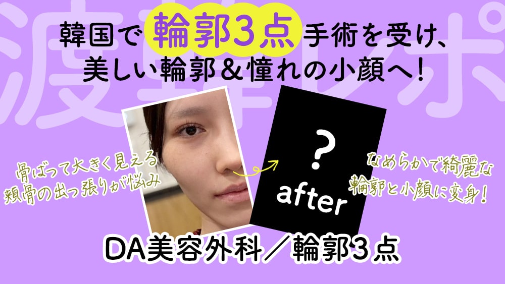 DA美容外科で輪郭3点 美しい輪郭＆憧れの小顔へ！【渡韓美容整形レポ：vol.6】