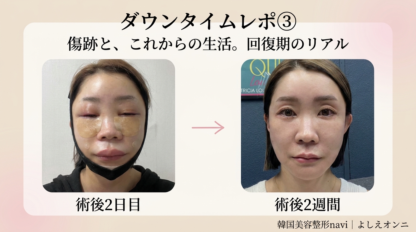 【ダウンタイムレポ③】傷跡と、これからの生活。48歳・回復期のリアル記録