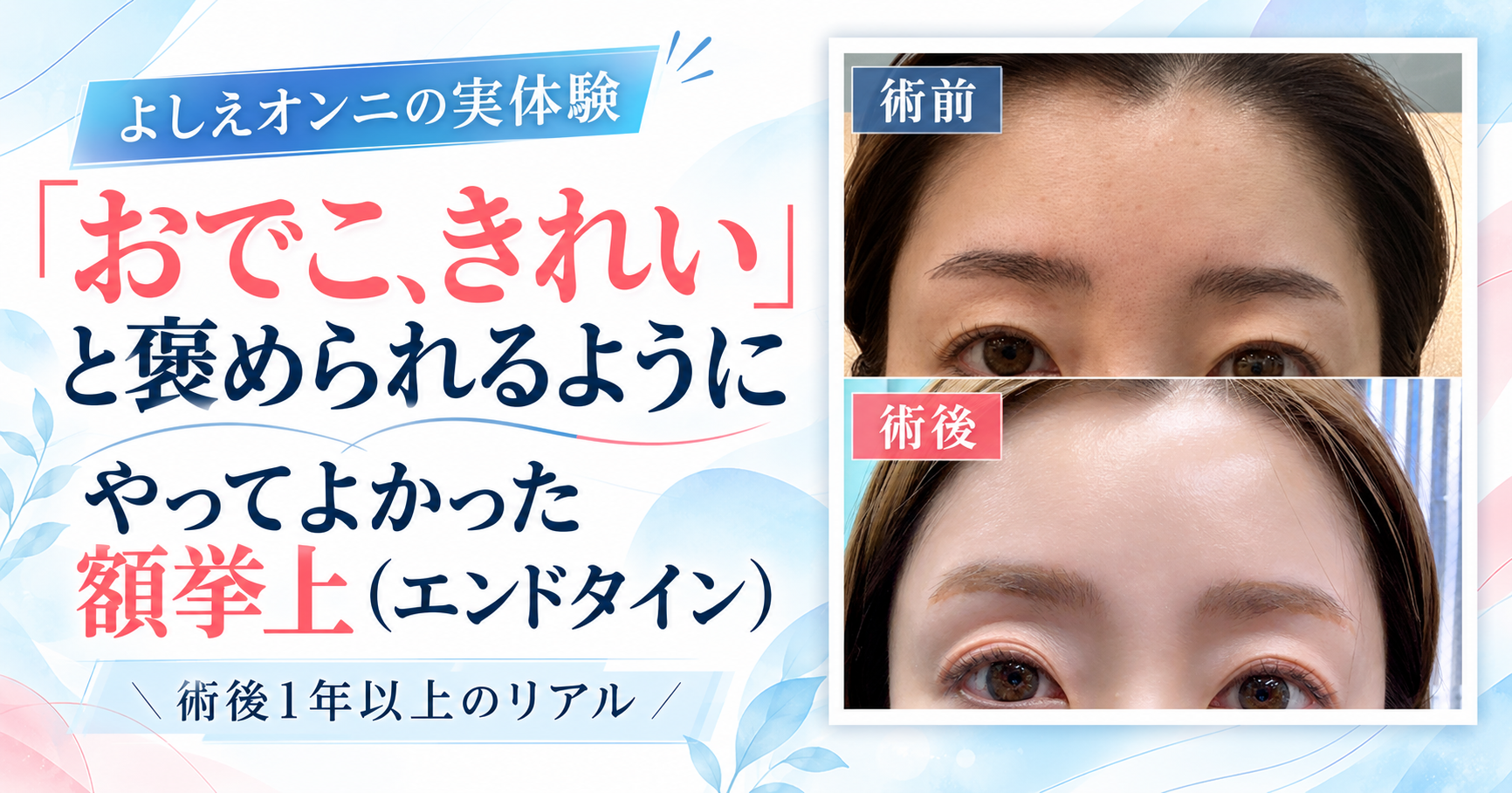 【術後1年】「おでこ、きれい」と褒められるように。やってよかった額挙上(エンドタイン)