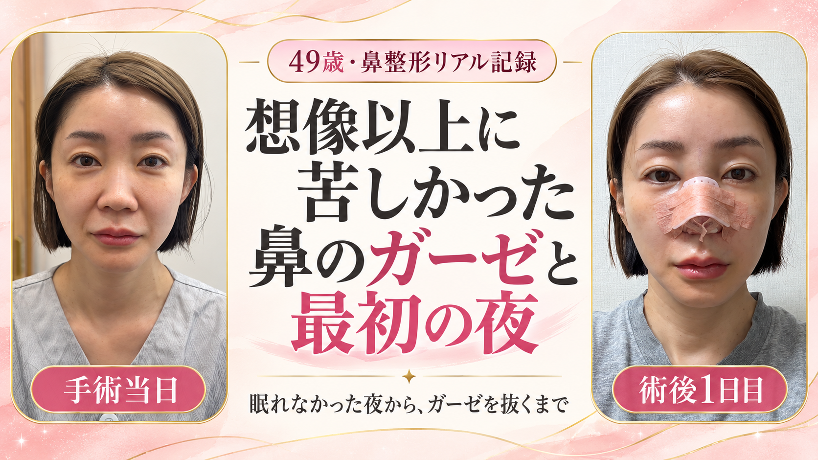 鼻整形、想像以上に苦しかった最初の夜。術後1日目に鼻のガーゼを抜くまで