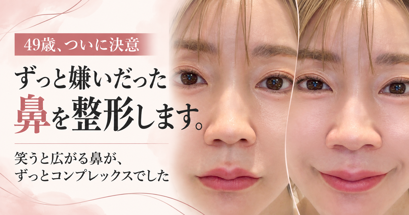 49歳、何十年も嫌いだった鼻を整形します。怖くても決意した理由